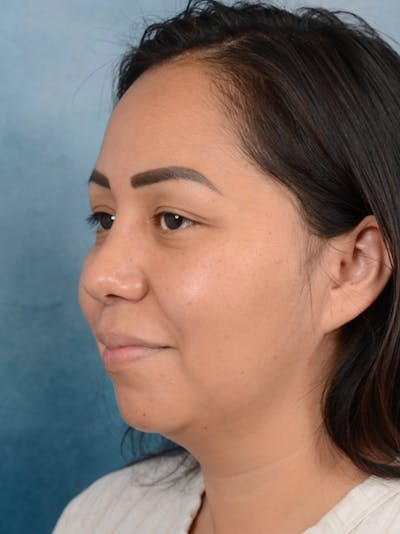 Rhinoplasty Before & After Gallery - Patient 57576535 - Image 6