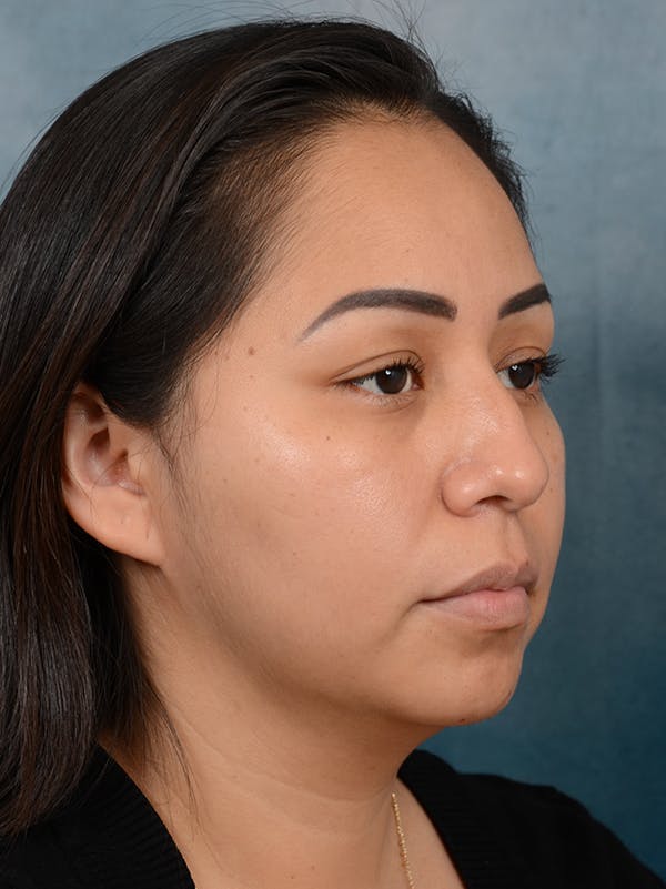 Rhinoplasty Before & After Gallery - Patient 57576535 - Image 7