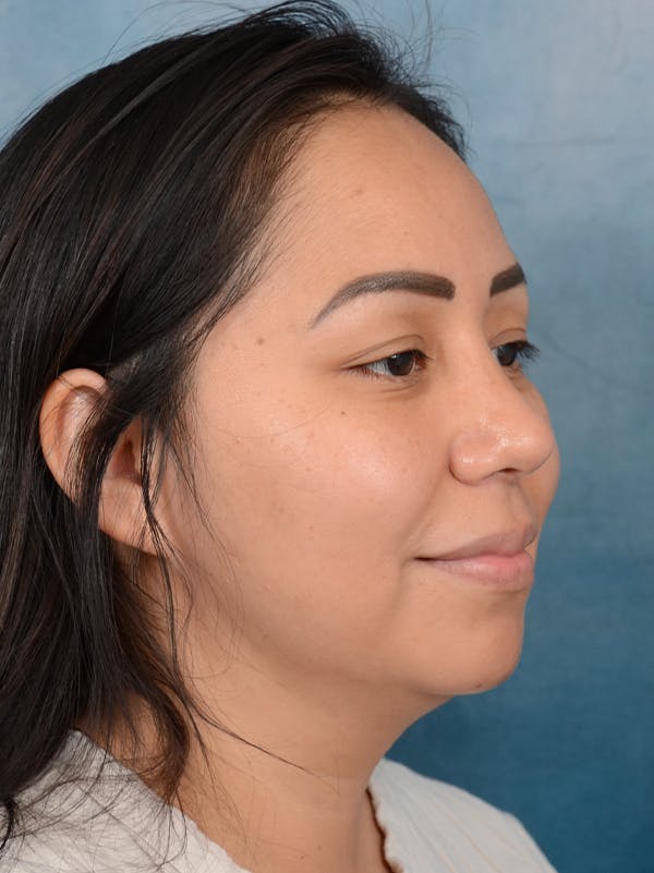 Rhinoplasty Before & After Gallery - Patient 57576535 - Image 8
