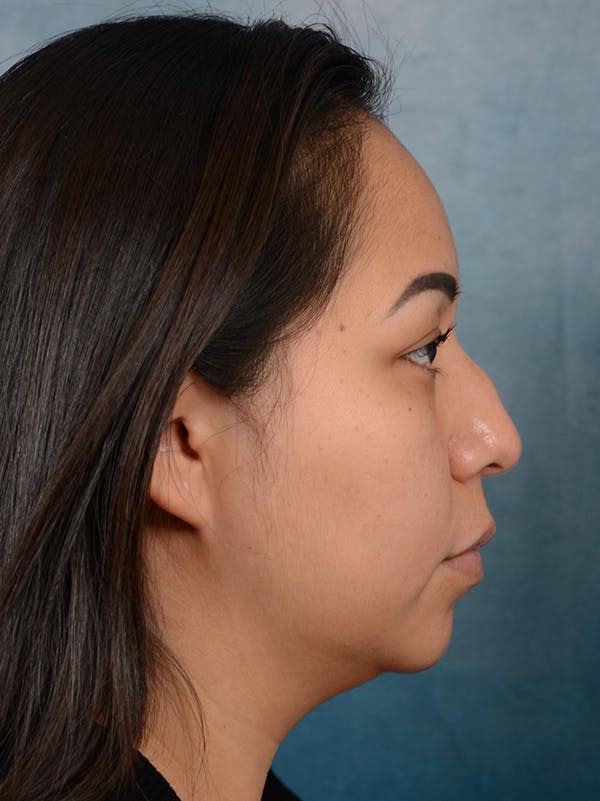 Rhinoplasty Before & After Gallery - Patient 57576535 - Image 9