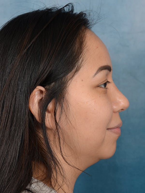 Rhinoplasty Before & After Gallery - Patient 57576535 - Image 10