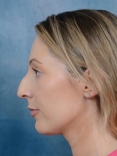 Rhinoplasty Before & After Gallery - Patient 61874293 - Image 1