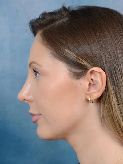 Rhinoplasty Before & After Gallery - Patient 61874293 - Image 2