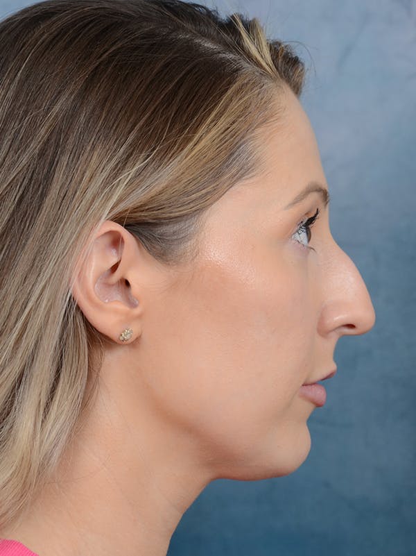 Rhinoplasty Before & After Gallery - Patient 61874293 - Image 9