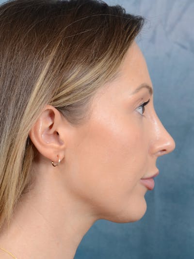 Rhinoplasty Before & After Gallery - Patient 61874293 - Image 10