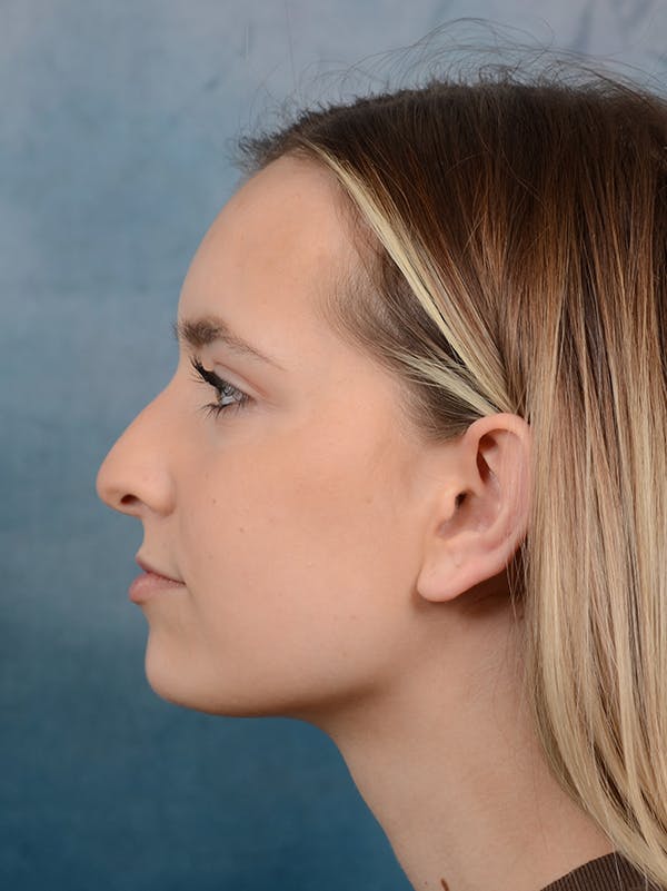 Rhinoplasty Before & After Gallery - Patient 61874294 - Image 1