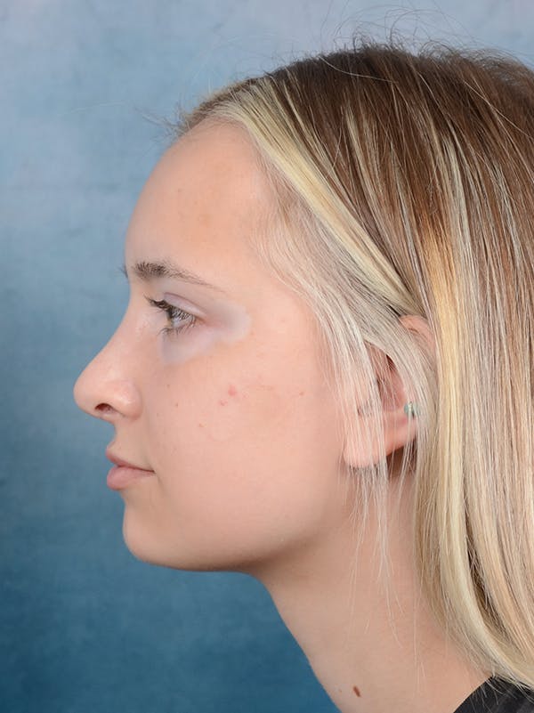 Rhinoplasty Before & After Gallery - Patient 61874294 - Image 2