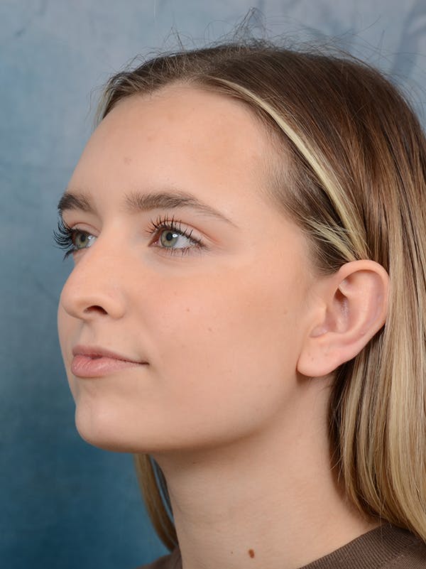 Rhinoplasty Before & After Gallery - Patient 61874294 - Image 5