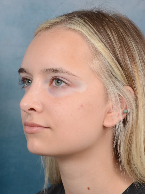 Rhinoplasty Before & After Gallery - Patient 61874294 - Image 6