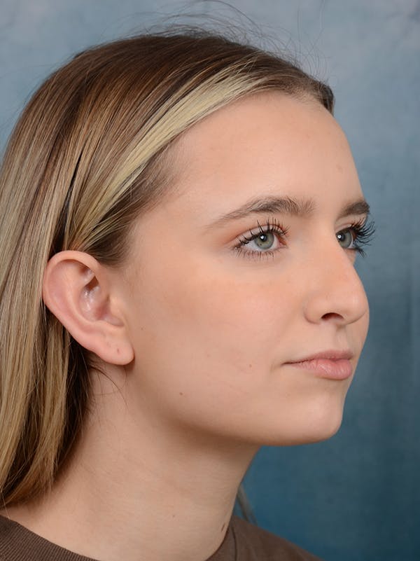 Rhinoplasty Before & After Gallery - Patient 61874294 - Image 7