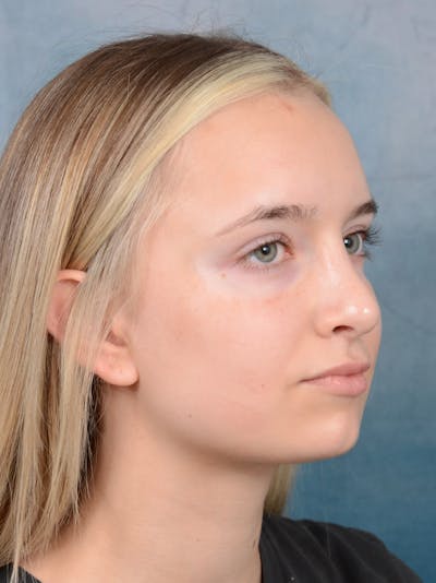 Rhinoplasty Before & After Gallery - Patient 61874294 - Image 8