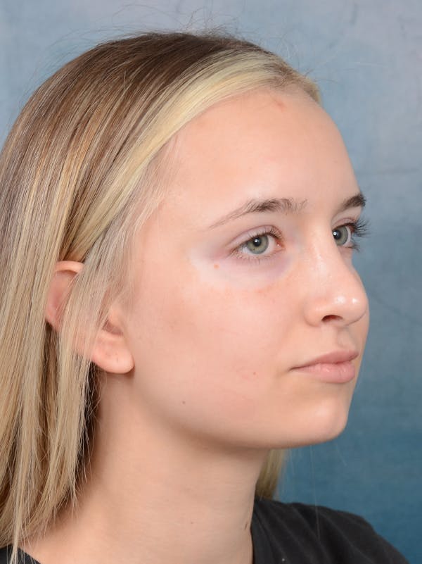Rhinoplasty Before & After Gallery - Patient 61874294 - Image 8