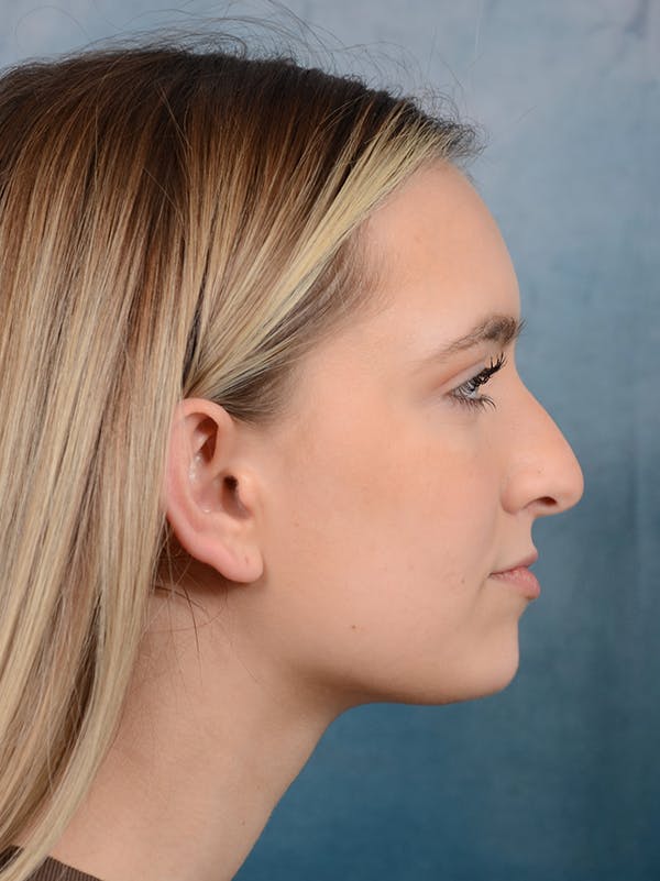 Rhinoplasty Before & After Gallery - Patient 61874294 - Image 9