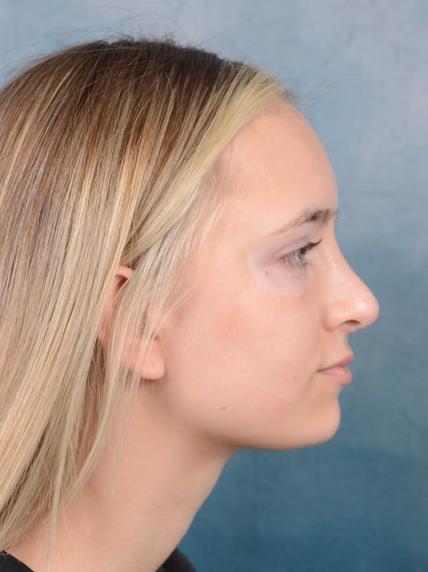 Rhinoplasty Before & After Gallery - Patient 61874294 - Image 10
