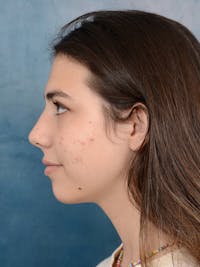 Rhinoplasty Before & After Gallery - Patient 65489720 - Image 1
