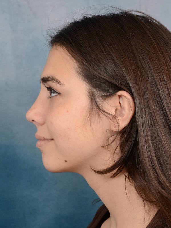 Rhinoplasty Before & After Gallery - Patient 65489720 - Image 2