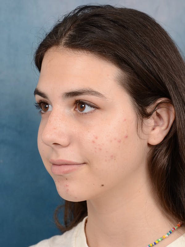 Rhinoplasty Before & After Gallery - Patient 65489720 - Image 5