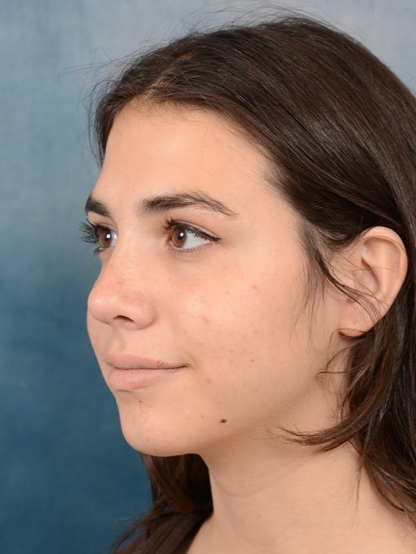 Rhinoplasty Before & After Gallery - Patient 65489720 - Image 6