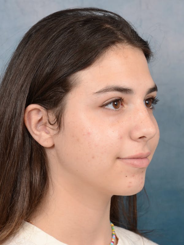 Rhinoplasty Before & After Gallery - Patient 65489720 - Image 7