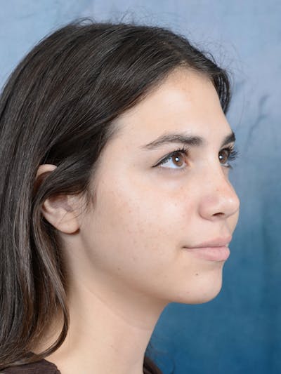 Rhinoplasty Before & After Gallery - Patient 65489720 - Image 8