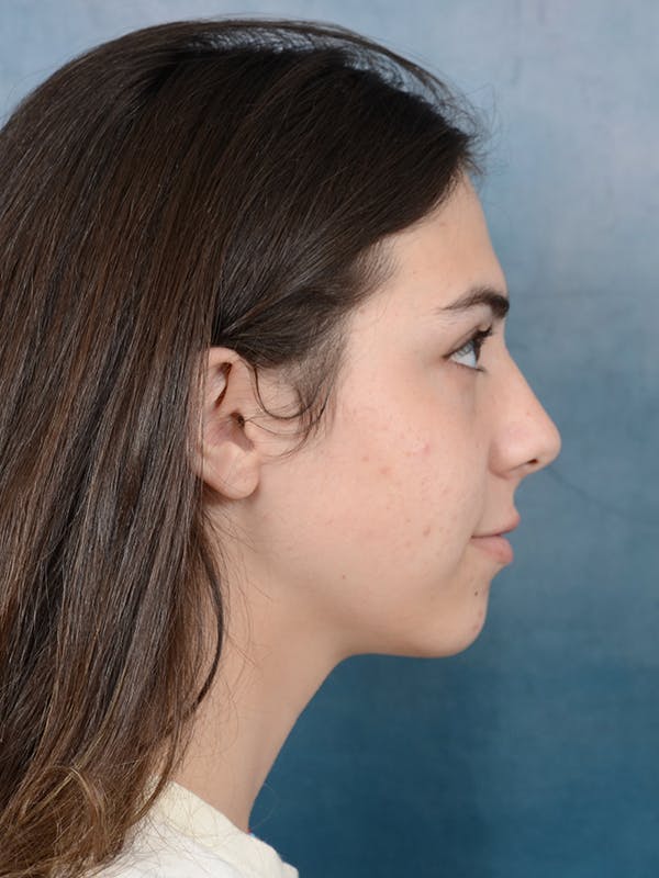 Rhinoplasty Before & After Gallery - Patient 65489720 - Image 9