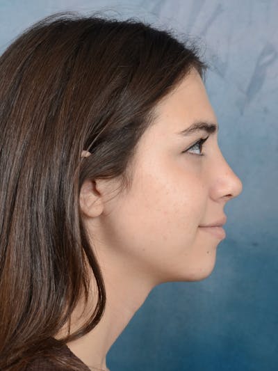Rhinoplasty Before & After Gallery - Patient 65489720 - Image 10
