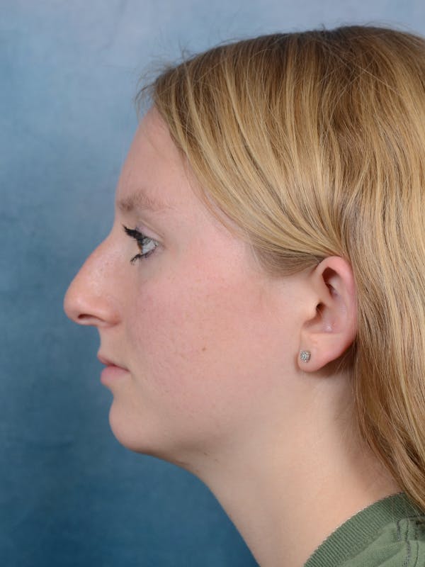 Rhinoplasty Before & After Gallery - Patient 65489721 - Image 1