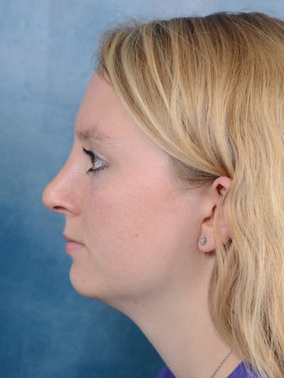 Rhinoplasty Before & After Gallery - Patient 65489721 - Image 2
