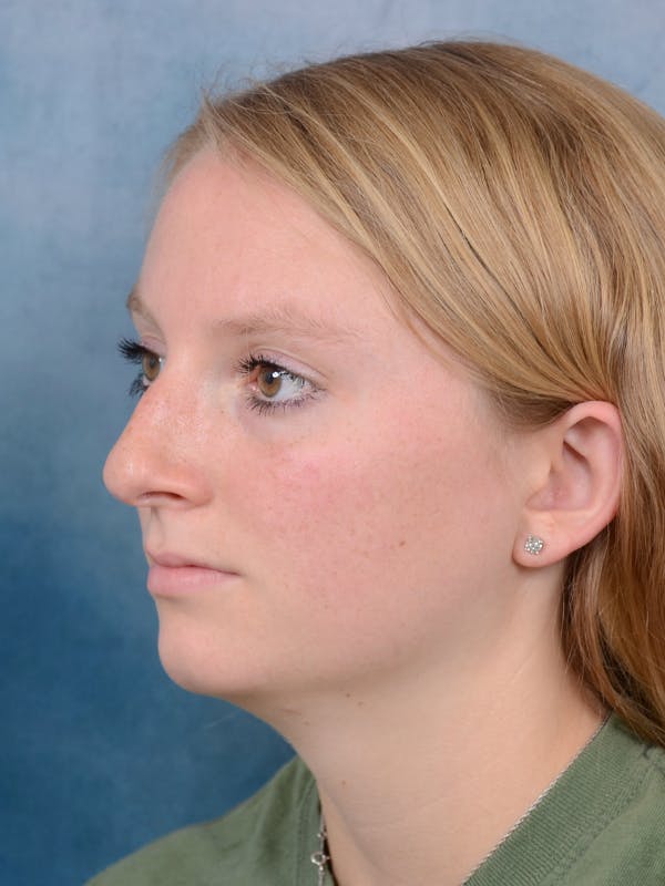 Rhinoplasty Before & After Gallery - Patient 65489721 - Image 5