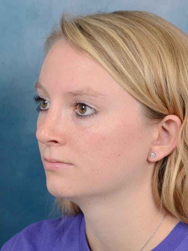 Rhinoplasty Before & After Gallery - Patient 65489721 - Image 6