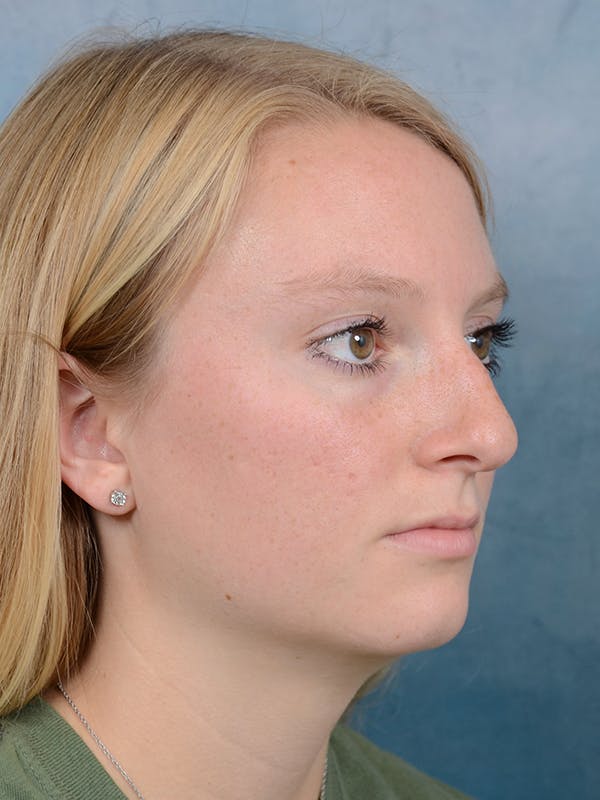 Rhinoplasty Before & After Gallery - Patient 65489721 - Image 7