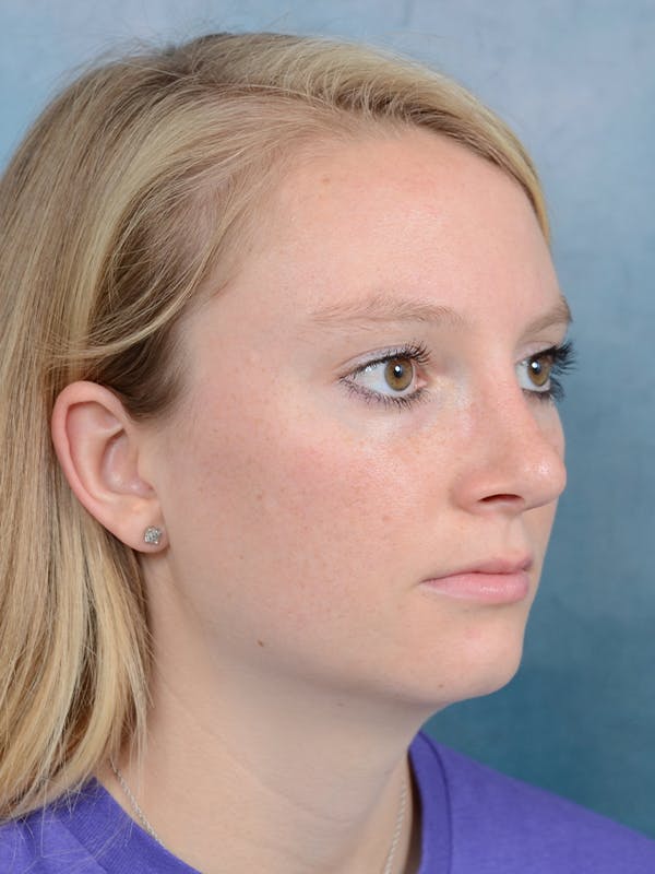Rhinoplasty Before & After Gallery - Patient 65489721 - Image 8