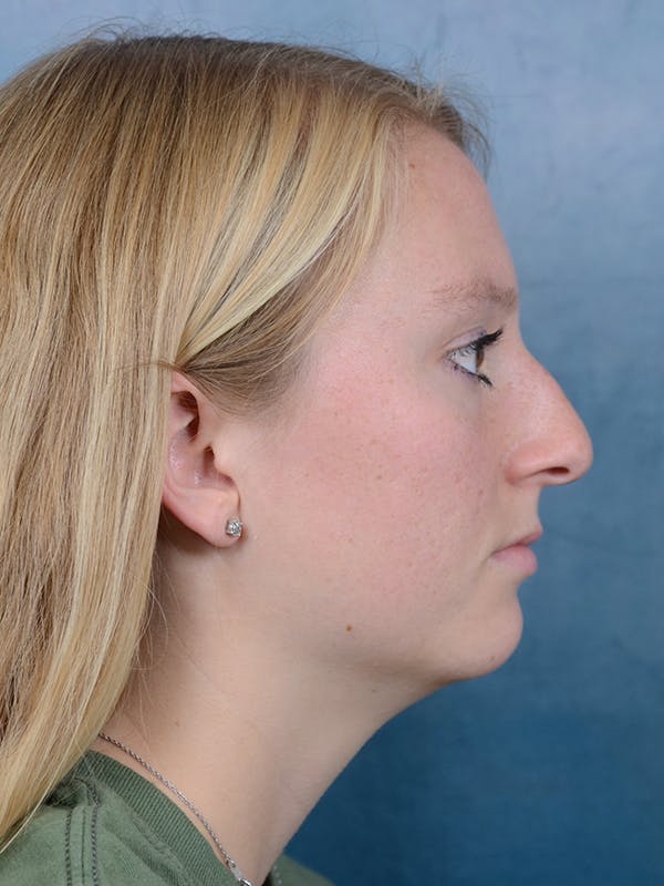 Rhinoplasty Before & After Gallery - Patient 65489721 - Image 9