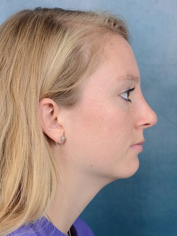 Rhinoplasty Before & After Gallery - Patient 65489721 - Image 10