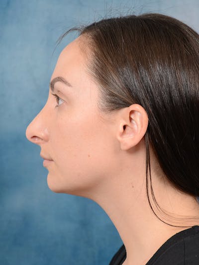 Revision Rhinoplasty Before