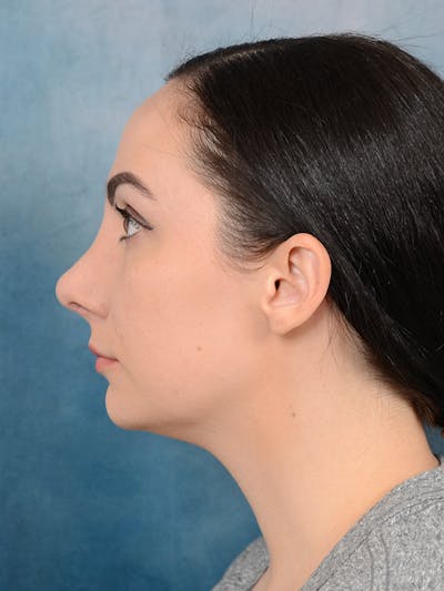 Revision Rhinoplasty After