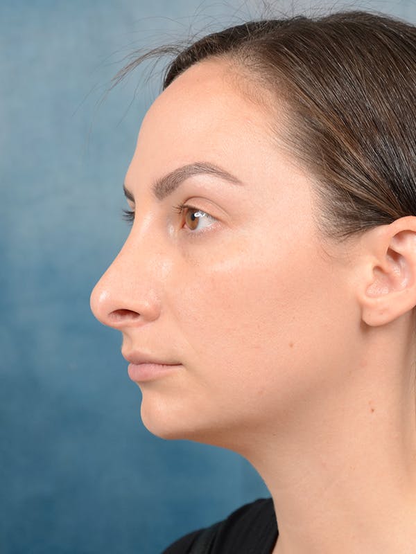Revision Rhinoplasty Before & After Gallery - Patient 65489739 - Image 5