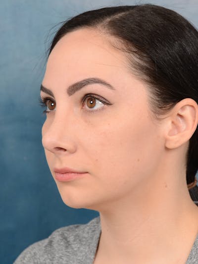 Revision Rhinoplasty Before & After Gallery - Patient 65489739 - Image 6