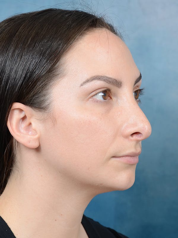 Revision Rhinoplasty Before & After Gallery - Patient 65489739 - Image 7