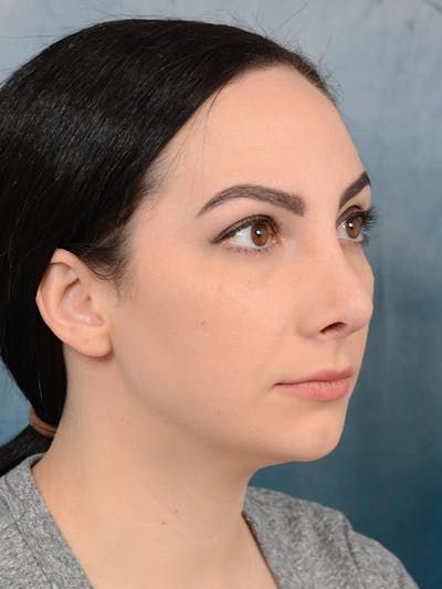 Revision Rhinoplasty Before & After Gallery - Patient 65489739 - Image 8