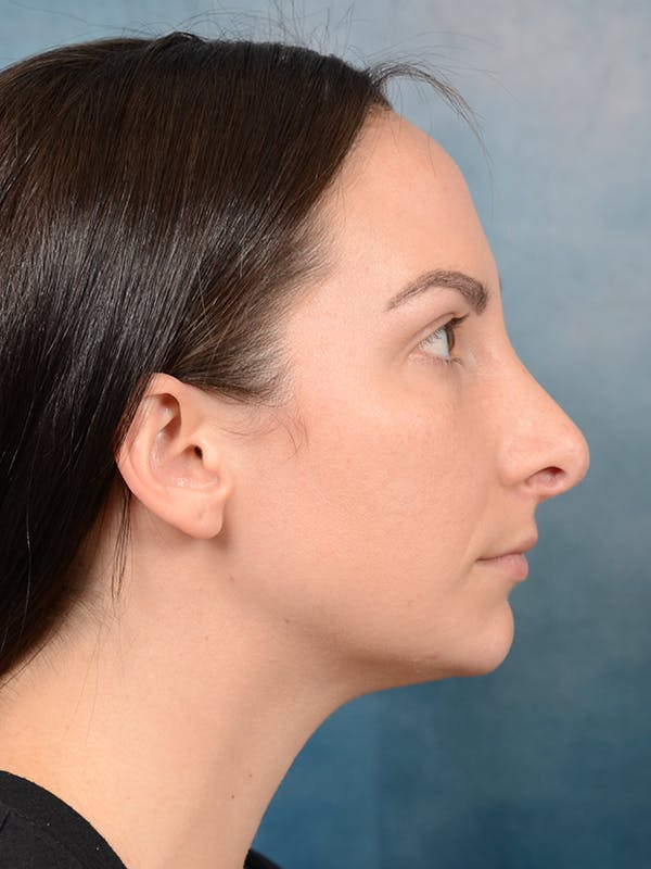 Revision Rhinoplasty Before & After Gallery - Patient 65489739 - Image 9