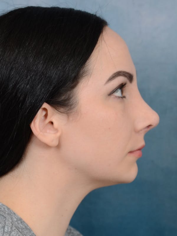 Revision Rhinoplasty Before & After Gallery - Patient 65489739 - Image 10