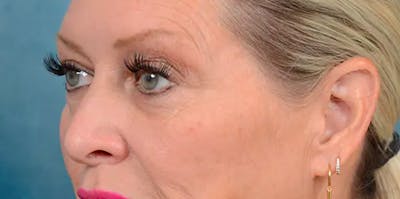 Lower Eyelid Lift with Fat Grafting Before