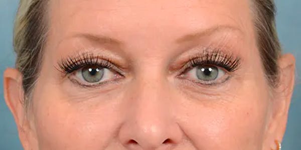 Eyelid Lift Gallery - Patient 61874334 - Image 3