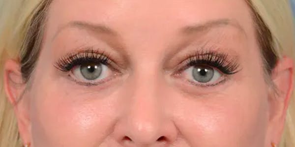 Eyelid Lift Before & After Gallery - Patient 61874334 - Image 4