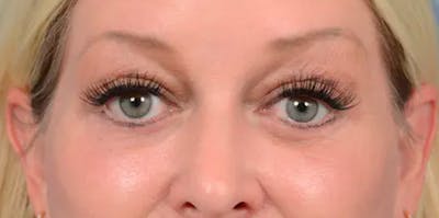 Eyelid Lift Before & After Gallery - Patient 61874334 - Image 4