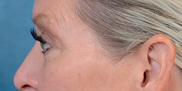 Eyelid Lift Before & After Gallery - Patient 61874334 - Image 5