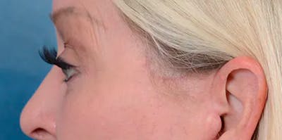 Eyelid Lift Before & After Gallery - Patient 61874334 - Image 6