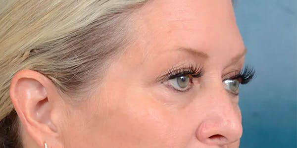 Eyelid Lift Before & After Gallery - Patient 61874334 - Image 7