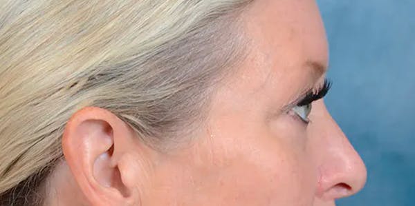 Eyelid Lift Before & After Gallery - Patient 61874334 - Image 9